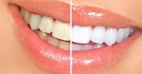Ako si vybrať gel na bielenie zubov?