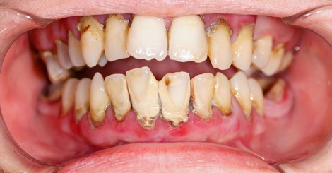 Parodontitída - ako vzniká a čo s ňou?