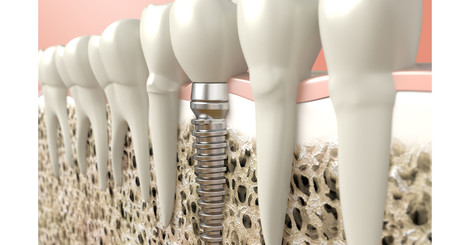 Zubné implantáty a všetko o nich