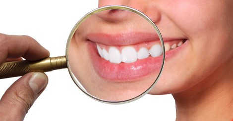 Na čo sa najčastejšie pýtate o bielení zubov