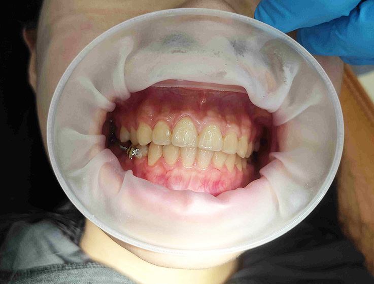 Ztdental rozvierač 320 ks - Large